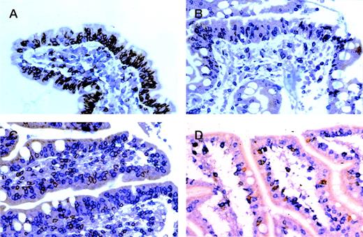 Fig. 2. Enteropathic mucosa from cases of (A) gluten-responsive celiac disease, (B) refractory sprue, (C) ulcerative jejunitis, and (D) EATL sequentially immunostained for CD8 (peroxidase-brown) and CD3 (alkaline phosphatase-blue). In (A) IEL are predominantly CD8+ (brown) with only occasional CD3+, CD4/8− (blue) cells. Note predominance of CD3+, CD4+ (blue) cells in the lamina propria. In (B through D), most IEL are CD3+, CD4/8− (blue) with only occasional CD8+(brown) cells.