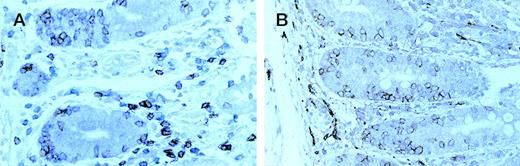 Fig. 3. Enteropathic mucosa from a case of type B EATL . (A) sequentially immunostained for CD8 (peroxidase-brown) and CD3 (alkaline phosphatase-blue); (B) immunostained for CD56 (peroxidase-brown). Most IEL are CD8+ (brown in A) and CD56+.