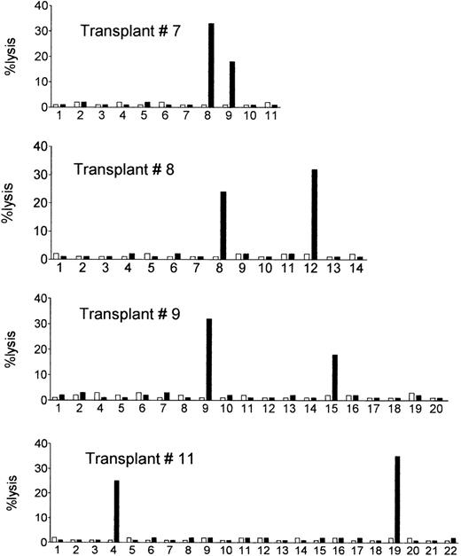Fig. 1. Posttransplant NK cell clones of donor origin lyse the allogeneic recipient’s target cells. Donor NK cell clones obtained from the circulation of the engrafted recipients were tested for lysis of the allogeneic recipient’s target cells (PHA lymphoblasts or BLCLs obtained from cryopreserved pretransplant recipient’s lymphocytes) (▪), and of the autologous donor’s cells (□). E:T ratio = 10:1. Shown are cytotoxicity assays with NK cell clones from four representative recipients (see Table 3 for a summary of data).