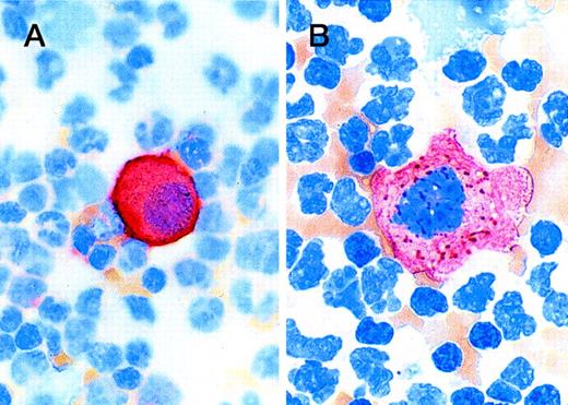 Fig. 4. Photomicrograph shows staining patterns of tumor cells detected in peripheral blood. (A) Cell detected with the Bre-3 anti–MUC-1 antibody; (B) tumor cell detected with AE1/AE3 anti-cytokeratin cocktail. There is cell membrane staining in the anti–MUC-1 preparation and coarse granular or fibrillary cytoplasmic staining of tumor cells with anti-cytokeratin, consistent with the distribution of cytokeratin intermediate filaments.