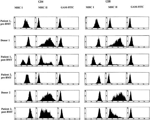 Fig. 1. FACS analysis of CD4+ and CD8+ T-cell subsets before and 1 year after allo-BMT. FACS profiles are given for BLS patients 1 (top) and 2 (bottom) and their respective BM donors, after labeling of PHA/rIL-2–stimulated CD4+ and CD8+ T-cell subsets with MoAb W6/32 directed against MHC class I and subsequent staining with fluorescein (FITC)-conjugated goat anti-mouse MoAb or after a direct staining with an FITC-conjugated MHC class II–directed MoAb (BD -HLA-DR); GAM-FITC was used as a negative control.
