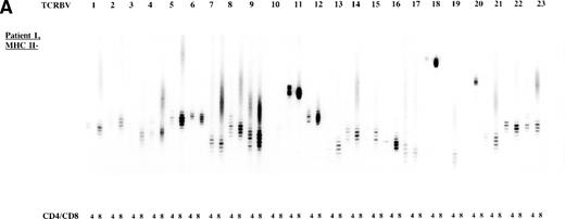 Fig. 2. TCR CDR3 size distribution (spectratype) analysis of overall peripheral TCRBV repertoires in CD4+ and CD8+ T-cell subsets after sorting for MHC class II expression. (A) Results of the TCR CDR3 size distribution analysis in patient 1 before allo-BMT, ie, MHC class II–negative fractions in CD4+ and CD8+ T-cell subsets. (B) Patient 1 one year after allo-BMT, T-cell subsets divided in MHC class II–expressing (MHC II+) or lacking (MHC II−) T-cell fractions. (C) Donor 1. From left to right, TCRBV families 1-23 are depicted in CD4+ and CD8+ T-cell subsets.