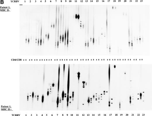 Fig. 2. TCR CDR3 size distribution (spectratype) analysis of overall peripheral TCRBV repertoires in CD4+ and CD8+ T-cell subsets after sorting for MHC class II expression. (A) Results of the TCR CDR3 size distribution analysis in patient 1 before allo-BMT, ie, MHC class II–negative fractions in CD4+ and CD8+ T-cell subsets. (B) Patient 1 one year after allo-BMT, T-cell subsets divided in MHC class II–expressing (MHC II+) or lacking (MHC II−) T-cell fractions. (C) Donor 1. From left to right, TCRBV families 1-23 are depicted in CD4+ and CD8+ T-cell subsets.
