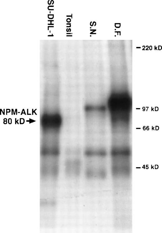 Fig. 2. Results from an in vitro kinase assay. Proteins were extracted from cryostat tissue sections, immunoprecipitated with anti-ALK, and incubated with radioactive kinase substrate. The samples were then resolved using sodium dodecyl sulfate-polyacrylamide gel electrophoresis followed by autoradiography. Phosphorylated proteins of 97 kD and 104 kD were detected in tumor tissue from patients S.N. and D.F., respectively. 80-kD phosphorylated NPM-ALK was present in the t(2;5)+ cell line SU-DHL-1. No ALK proteins were present in the tonsil lysates used as negative controls.