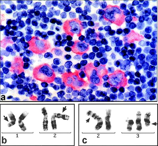 Fig. 1. (a) Section of a paraffin-embedded lymph node from patient D.F. stained for ALK1 expression (alkaline phophatase-technique). Large pleomorphic tumor cells show marked cytoplasmic but no nuclear immunostaining. (b) G-banded partial karyotype of patient D.F. exhibiting the translocation t(1;2)(q21;p23) (arrows). (c) G-banded partial karyotype of patient S.N. showing the t(2;3)(p23;q21) (arrows) and, additionally, a +del(3)(p21).
