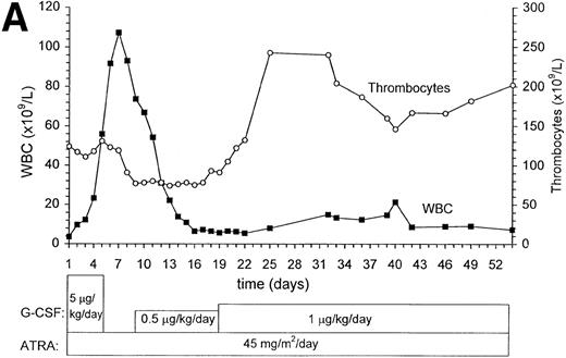 Fig. 3. Peripheral blood counts during ATRA plus G-CSF treatment. During ATRA and G-CSF treatment, platelet and WBC counts were determined (A). Cytological differentiation of peripheral blood smears was assessed daily. The percentage of promyelocytes, (meta)myelocytes, band cells, and segmented granulocytes was scored. From the total WBC counts, the absolute numbers of cells with the various stages of differentiation was calculated (B). The treatment regimen is indicated at the bottom.
