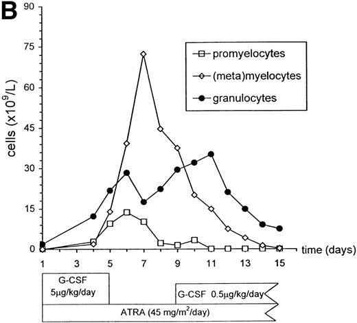 Fig. 3. Peripheral blood counts during ATRA plus G-CSF treatment. During ATRA and G-CSF treatment, platelet and WBC counts were determined (A). Cytological differentiation of peripheral blood smears was assessed daily. The percentage of promyelocytes, (meta)myelocytes, band cells, and segmented granulocytes was scored. From the total WBC counts, the absolute numbers of cells with the various stages of differentiation was calculated (B). The treatment regimen is indicated at the bottom.