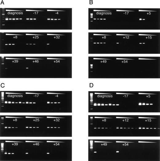 Fig. 5. PLZF-RAR and RAR-PLZF expression in bone marrow and blood cells during ATRA and G-CSF treatment. RNA from sequential bone marrow (A and C) and peripheral blood samples (B and D) was obtained and RT-PCR for PLZF-RAR (A and B) or RAR-PLZF (C and D) fusion transcripts was performed. Transcripts were quantified by serial, 10-fold dilutions of the patient cells in t(11;17)-negative cells, and subsequent RNA isolation and RT-PCR. The dilution at which amplification of the transcript is lost indicates the abundance of the fusion transcript. For each sample, an undiluted and five 10-fold dilutions were processed (left to right). Numbers indicate days before (negative numbers) or after the start of treatment. In addition to sequential samples taken at the time of relapse, a sample from the initial first diagnosis was analyzed. To verify proper RNA isolation and reverse transcription, a control amplification was performed on each sample using primers that are specific for unrearranged RAR transcripts (not shown). For uniformity, RNA isolation, reverse transcription, and PCR was performed on all samples at the same time. The specificity of the amplification was confirmed by Southern blotting and hybridization with oligonucleotide probes spanning the respective fusion points (not shown). Data are representative of 3 independent experiments.