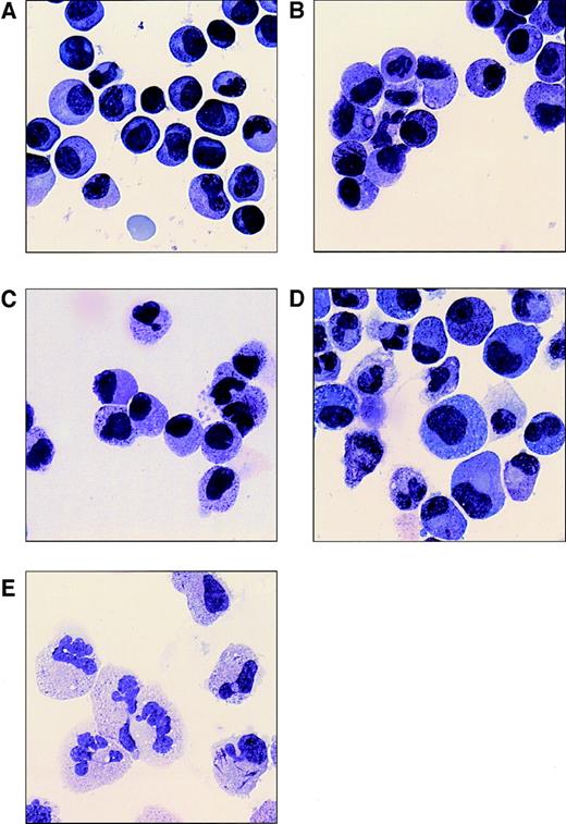 Fig. 2. Morphology of t(11;17) positive leukemia cells cultured with G-CSF and ATRA. Mononuclear cells, consisting of more than 90% of leukemic cells, were isolated from the blood at first diagnosis and cultured under various conditions for up to 14 days. Cytospins were made after various time intervals and stained with May-Grünwald-Giemsa. Depicted are uncultured cells (A) and cells that were grown for 1 week in medium (B), 10−6 mol/L ATRA (C), 0.1 μg/mL G-CSF (D), and ATRA and G-CSF (E).