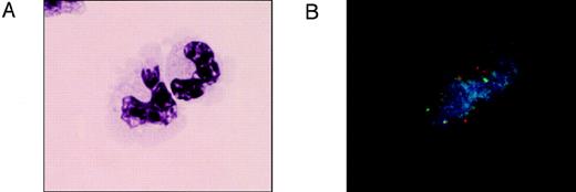 Fig. 4. In vivo maturation of t(11;17) FISH-positive leukemia cells. Twelve days after initiation of ATRA and G-CSF treatment, FISH-positive cells in bone marrow and blood predominantly showed segmented nuclei (as visualized by DAPI staining) indicative of granulocytic differentiation of the leukemic cells. To establish the morphology of the FISH-positive cells, slides were stained with May-Grünwald-Giemsa (A). The same fields were photographed after hybridization of the slides with labeled FISH probes (B) to obtain dual morphological and FISH staining. The t(11;17) translocation is indicated by the colocalization of red and green signals.