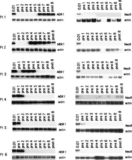 Fig. 2. PCR assay showing the presence of MDR1 and NeoR transgene in granulocytes for all patients enrolled on the study. In each set of MDR1 panels, the top gel shows the nestedMDR1 primers, and the bottom panels show the control for the amount of DNA placed in PCR reaction using primers for the actin gene. The NeoR gels show the results for the nested NeoR primers.
