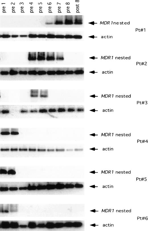 Fig. 3. PCR assay showing the presence of the MDR1transgene in monocytes obtained from the patients enrolled in the study. In each set of MDR1 panels, the top gel shows the nestedMDR1 primers, and the bottom panel shows the control for the amount of DNA placed in PCR reaction using primers for the actin gene.