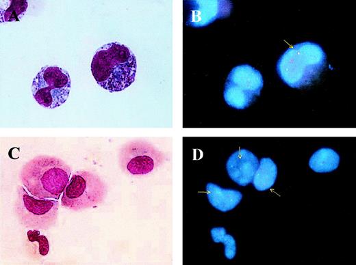 Fig. 5. BM samples before (A and B) and during (C and D) As2O3 treatment were collected for analyzing the origin of differentiated myeloid cells. Morphological examination (A and C) showed promyelocytes (A) and myelocyte-like cells (C), in which one red, one green, and one yellow fusion signal could be observed in the same cells (B and D). Arrows pointed yellow signals that represented PML- RAR fusion gene.