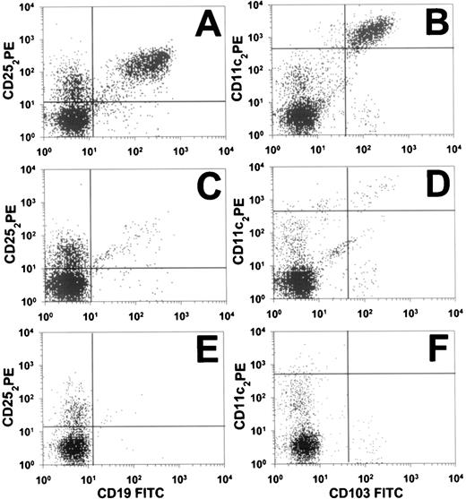 Fig. 1. Flow cytometry (FACS) analysis of circulating cells in HCL patient no. 30. At 3 different time points, pretreatment (A and B), cycle 1 day 8 (C and D), and cycle 2 day 145 (E and F), data from 2-color analyses are shown to identify CD25+/CD19+ cells (A, C, and E) or CD11c+/CD103+ cells (B, D, and F). Perpendicular lines were drawn to differentiate malignant (upper-right quadrants) from nonmalignant cells. Horizontal lines in (B), (D), and (F) are drawn above nonmalignant cells that are dimly positive for CD11c.