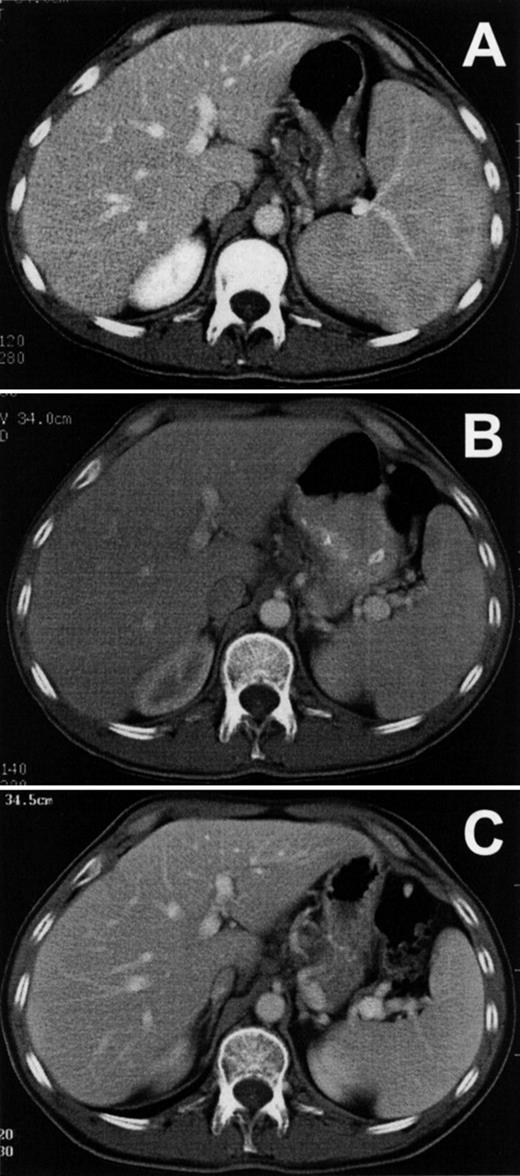Fig. 3. Reduction of spleen size in HCL. Axial sections are shown from computed tomography performed on patient no. 1 before (A) and after (B) the first cycle of LMB-2 and then on day 175 of the second cycle (C).