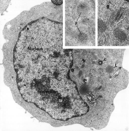 Early erythroblastic leukemia. This leukemic blast cell displays typical ultrastructure. The nucleus contains mainly euchromatin and prominent nucleolus structures. Characteristic granules called θ granules (θ) because they resemble the greek letter theta and ferritin containing granules (F) are present in the juxta-nuclear region near the centriole (c). Large size mitochondria (m) and lipid inclusions (L) are frequent (original magnification ×18,000). (Inset) High magnification of the characteristic granule ultrastructure. Ferritin molecules are identified in the granules by their density and shape (F). θ granules exhibit complex internal structures (original magnification ×54,600). (Courtesy of Elisabeth M. Cramer, MD, PhD, INSERM U. 474, Hopital Henri Mondor, 51 av. du Marechal de Lattre-de-Tassigny, Creteil 94010, France.)