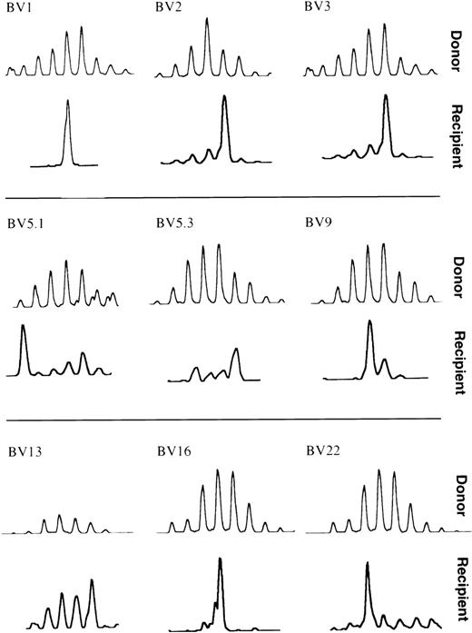 Fig. 1. Spectratype analysis of 1 representative donor and recipient pair (UPN688). The donor data are from a pretransplant PBMC sample. The recipient data are from PBMC obtained 7 years posttransplant. The histograms show the TCR profile of 9 different BV families (indicated on top of each pair of spectratypes). The donor or recipient origin of each spectratype is identified on the right.