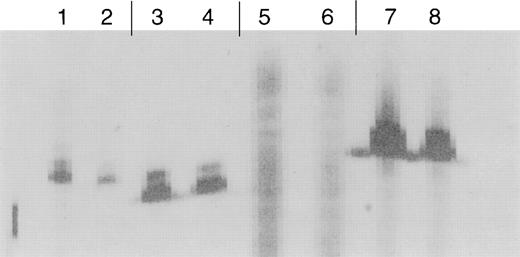 Fig. 2. SSCP analysis of predominant spectratype bands. Each pair of lanes represents data derived from different samples. Lanes 1 and 2, BV2 from UPN688; lanes 3 and 4, BV20 from UPN855; and lanes 7 and 8, BV5.3 from UPN1074. Lanes 5 and 6 show results from the analysis of a normal, polyclonal spectratype band. In each case, the first lane represents PCR in which twice the amount of cDNA was used.