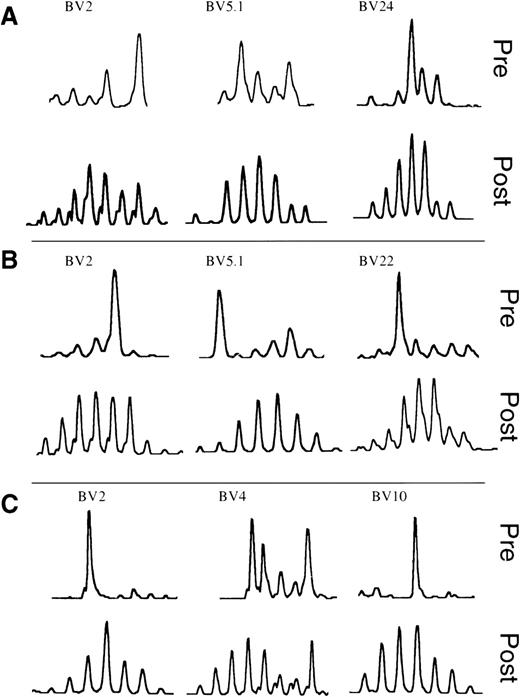 Fig. 3. Spectratype analysis of in vitro culture with PHA. PBMCs from UPN688 (A), UPN885 (B), and UPN1074 (C). For each patient, the TCR profiles of 3 representative BV families (indicated on top of each pair of spectratypes) are shown. The spectratype of the PBMC before culture (pre) is shown at the top of each panel and that after the culture (post) is shown on the bottom.