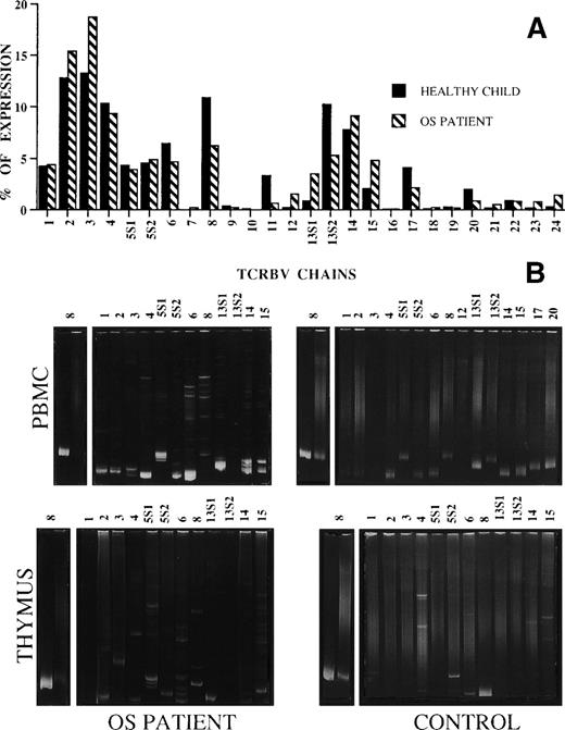 Fig. 2. (A) Expression of TCRBV segments by OS (▧) and a healthy age-matched infant (▪) PBMC. The data are expressed as the percentage of the color- imetric signal obtained with the individual TCRBV-specific probes. (B) Heteroduplex analysis of the indicated TCRBV chains’ PCR products of PBMC and thymocytes from the OS patient and the healthy control. On the right of each gel, monoclonal and polyclonal controls, prepared by loading in the gel the products obtained from TCRBV8-specific PCR amplification of the RNA of monoclonal (J77) and polyclonal (C1.632) cell populations,21 are shown.