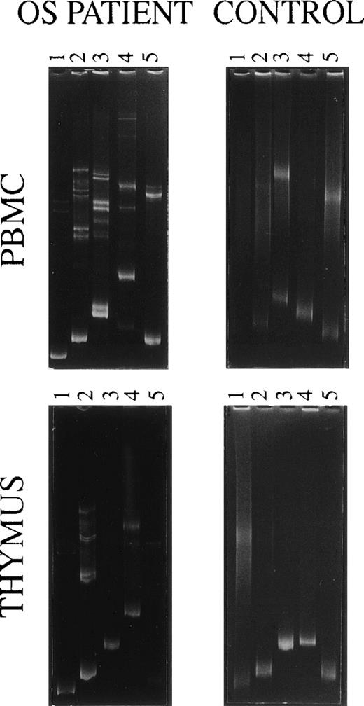 Fig. 3. Heteroduplex analysis of the indicated TCRDV chains’ PCR products of PBMC and thymocytes from the OS patient and an age-matched control.