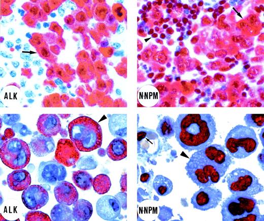 Fig. 1. Immunostaining of an ALK-positive lymphoma bearing the t(2;5) translocation (top left and right). (Top left) Immunostaining for ALK protein. Tumor cells (arrow) show strong cytoplasmic and nuclear ALK expression. Residual lymphoid tissue is ALK-negative (original magnification × 800). (Top right) Tumor cells (arrow) show cytoplasmic and nuclear positivity for the N-terminus of NPM (N-NPM). Cytoplasmic positivity reflects immunostaining of the NPM moiety of the NPM-ALK fusion protein. Normal residual lymphoid cells (arrowhead) show wild-type nucleus-restricted NPM staining (original magnification × 800). In contrast, immunostaining for the C-terminus of NPM showed a nucleus-restricted expression of the protein (not shown). (Bottom left and right) An example of ALK-positive lymphoma expressing variant ALK fusion protein. (Bottom left) Positivity for the ALK protein is restricted to the cytoplasm of the large anaplastic tumor cells (arrowhead; original magnification × 1,000; right). The N-terminus of NPM (N-NPM) shows nucleus-restricted expression both in tumor cells (arrowhead) and in a normal endothelial cell (arrow), reflecting immunostaining of wild-type NPM (original magnification × 1,000). An identical staining pattern (not shown) was observed for the C-terminus of NPM. (APAAP immunostaining on lymph node paraffin sections; hematoxylin counterstaining.)
