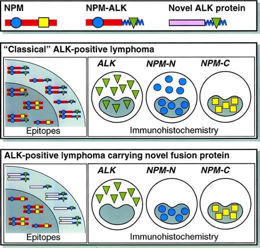 Fig. 2. Schematic illustration of the staining patterns for ALK and the N- and C-terminal portions of NPM in lymphomas carrying NPM-ALK or variant ALK fusion protein(s). Further details of the reactivity of the anti-NPM monoclonal antibodies have been published elsewhere.31
