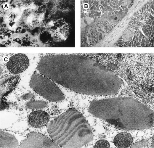 Fig. 4. Patient CHEB, kidney biopsy. (A) Immunofluorescence microscopy, anti-κ conjugate (original magnification × 500), heavy staining of cytoplasmic inclusions in proximal tubular cells. (B) Electron microscopy (original magnification × 2,600): numerous crystalline and osmiophilic inclusions in the cytoplasm of proximal tubular cells. (C) Electron microscopy (original magnification × 16,000): details of intracytoplasmic crystalline inclusions.