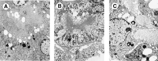 Fig. 5. Mutant CHEB mice and 269 mice kidneys. (A) MouseCHEBm30 no. 1, kidney, electron microscopy (original magnification × 6,000). (B) Mouse CHEBm94 no. 1, kidney, electron microscopy (original magnification × 2,500). (C) Mouse 269 no. 10, kidney, electron microscopy (original magnification × 4,000): moderate or heavy increase of lysosomal component in proximal tubular cells with variable apical vacuolation secondary to reabsorption of mutated CHEB or 269 LCs. Crystalline inclusions are absent in the lysosomal compartment.