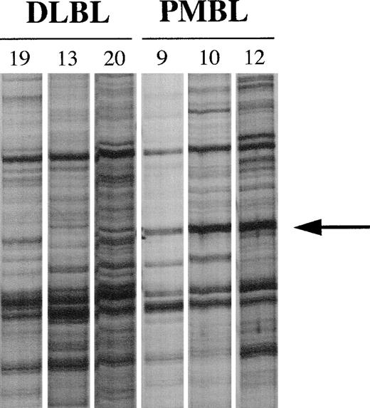Fig. 1. PCR differential screening. mRNA from tumor samples of 3 patients with peripheral DLBLs (patients no. 19, 13, and 20) and 3 patients with PMBLs (patients no. 9, 10, and 12) were reverse transcribed and amplified by PCR using the T12GC anchor primer and the OPA 18 arbitrary primer. Amplified cDNAs were run side by side on a 6% sequencing gel. The arrow indicates the band seen only in amplified cDNAs corresponding to patients with PMBL.