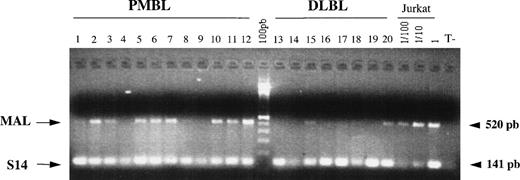 Fig. 3. RT-PCR analysis of MAL expression in PMBLs and peripheral DLBLs. One microgram of RNA extracted from 12 PMBLs and 8 peripheral DLBLs was reverse transcribed and the cDNAs were coamplified with MAL and S14 primers. PCR products were run on a 2% agarose gel stained with ethidium bromide. Specific amplification of MAL and S14 cDNAs produced 520- and 141-bp bands, respectively. Positive control represented by serial dilutions of Jurkat cDNA and a negative control without template (T−) are included.