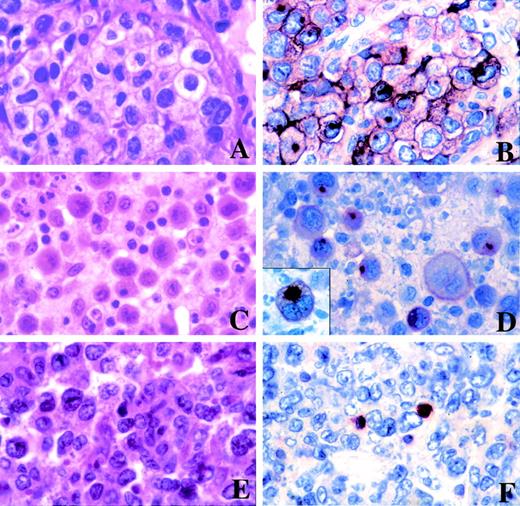 Fig. 4. Morphological features and immunostaining for MAL of PMBLs and peripheral DLBLs. (A) PMBL of centroblastic subtype with a clear-cell component (case no. 10). (B) Case no. 10 stained for the MAL protein showing surface membrane and granular cytoplasmic immunoreactivity with accentuation in the Golgi area of neoplastic cells. (C) PMBL of centroblastic polymorphic subtype with a anaplastic large-cell component (case no. 2). (D) Staining for MAL of case no. 2 showing membrane and striking paranuclear dot-like positivity in neoplastic cells (inset). (E) Peripheral DLBL of centroblastic multilobated subtype (case no. 17). (F) Staining for MAL of case no. 17 showing that the tumor cells lack expression of the MAL protein. Positive internal control are present, represented by small lymphoid cells, consistent with reactive T cells. (A, C, and E, hematoxylin-eosin stain; B, D, and F, immunohistochemical staining of paraffin section with the anti-MAL antibody, APAAP method.)