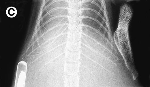 Fig. 2. Growth of purified myeloma plasma cells (PC) from patient no. 1 in a SCID-hu host. SCID-hu host was inoculated with sorted PC. (A) Human Ig concentrations. (B) Dot plot of CD38/CD45 flow cytometry profile of the cells. The sort window used to purify plasma cells is shown. (C and D) X-radiograms showing severe resorption of the myelomatous implanted bone (C) compared with the nonmyelomatous bone of the control host (D), implanted at the same time as (C).