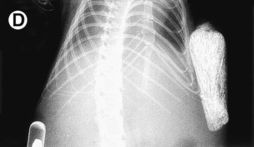 Fig. 2. Growth of purified myeloma plasma cells (PC) from patient no. 1 in a SCID-hu host. SCID-hu host was inoculated with sorted PC. (A) Human Ig concentrations. (B) Dot plot of CD38/CD45 flow cytometry profile of the cells. The sort window used to purify plasma cells is shown. (C and D) X-radiograms showing severe resorption of the myelomatous implanted bone (C) compared with the nonmyelomatous bone of the control host (D), implanted at the same time as (C).