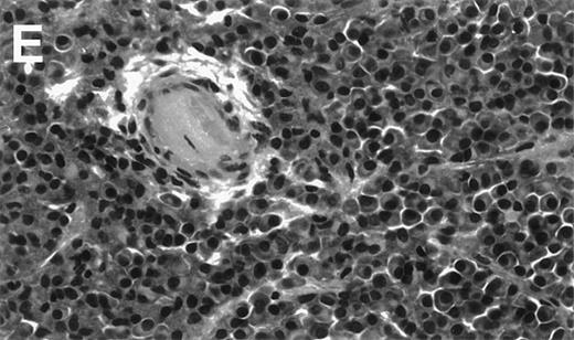 Fig. 3. Human Ig levels (A through C ) and histology of decalcified human bone sections ( D through F ) from SCID-hu hosts inoculated with bone marrow cells ( A and D ), purified plasma cells ( B and E ), and PC-depleted bone marrow cells ( C and F ) from patient no. 2. Inserts demonstrate CD38/CD45 fluorescent profiles and sort windows of cells used for each host.