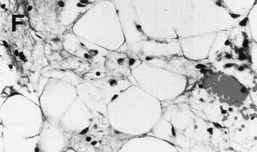 Fig. 3. Human Ig levels (A through C ) and histology of decalcified human bone sections ( D through F ) from SCID-hu hosts inoculated with bone marrow cells ( A and D ), purified plasma cells ( B and E ), and PC-depleted bone marrow cells ( C and F ) from patient no. 2. Inserts demonstrate CD38/CD45 fluorescent profiles and sort windows of cells used for each host.