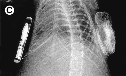 Fig. 4. Growth of myeloma blood cells from patient no. 10 in SCID-hu host. SCID-hu host was inoculated with blood cells (containing 0.1% plasma cells) and with PC-depleted blood cells. (A) Human Ig levels. (•) Blood cells; (○) PC-depleted blood cells; (▪) host inoculated with bone marrow cells containing 11% myeloma plasma cells. (B) Flow cytometry dot plot of CD38CD45 profile of the blood cells. The sort window excluding CD45− and CD45+plasma cells is shown. (C and D) X-radiograms of host injected with blood cells (C) and with PC-depleted blood cells (D). Note severe decalcification of myelomatous human bone in (C).