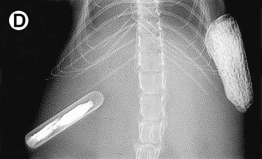 Fig. 4. Growth of myeloma blood cells from patient no. 10 in SCID-hu host. SCID-hu host was inoculated with blood cells (containing 0.1% plasma cells) and with PC-depleted blood cells. (A) Human Ig levels. (•) Blood cells; (○) PC-depleted blood cells; (▪) host inoculated with bone marrow cells containing 11% myeloma plasma cells. (B) Flow cytometry dot plot of CD38CD45 profile of the blood cells. The sort window excluding CD45− and CD45+plasma cells is shown. (C and D) X-radiograms of host injected with blood cells (C) and with PC-depleted blood cells (D). Note severe decalcification of myelomatous human bone in (C).