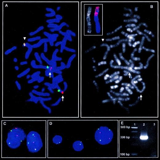 Fig. 1. Metaphase FISH with LSI ALK probe (A) and subsequent R-banding analysis (B) shows insertion of genomic material into theALK locus indicated by spatial separation of the red signal for 3′ALK (telomeric) and the green signal for 5′ALK(centromeric) on the short arms of both der(2) chromosomes (arrows) as compared with the intact chromosome 2 (arrowhead). (C) In interphase nuclei of tumor cells, insertion into the ALK locus on both derivative chromosome 2 leads to separation of 3′ and 5′ALKsignals in addition to each 1 colocalized, indicating the intactALK locus. (D) In contrast to the larger nucleus of the tumor cells, the smaller nuclei of nonneoplastic cells show 2 colocalized signals for 3′ and 5′ALK, which is the regular signal constellation for 2 intact chromosomes 2. (B, small picture) FISH with a chromosome 1 painting probe on R-banded chromosomes shows a major part of the short arm of the der(2) chromosomes to derive from chromosome 1. (E) RT-PCR amplifies a PCR product of approximately 300 bp specific for TPM3-ALK fusion (Lane 2). Lane 1, 100-bp ladder; lane 3: H2O control.