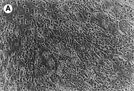 Fig. 6. (A) Representative phase contrast photomicrograph of pseudoemperipolesis of CLL B cells after 2-hour culture on the heterologous murine stromal cell line, M2-10B4. Cells that had not migrated beneath the stromal cells washed off, and the stromal cell layer containing the migrated CLL cells was photographed (200x magnification). Pseudoemperipolesis is characterized by the dark appearance of lymphocytes that have migrated into the same focal plane as the stromal cells. (B) For comparison, this photomicrograph shows reduced pseudoemperipolesis after pretreatment of CLL cells with pertussis toxin.