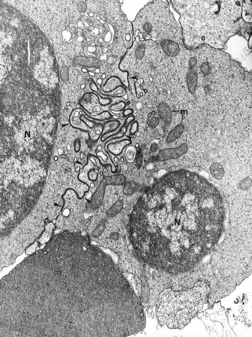 Fig. 2. The electron microscopic aspect of the bone marrow erythroblasts from patient 1: Cells are joined by interdigitating processes of the plasma membrane (arrowheads). They delineate areas of cytoplasm which are deprived of ribosomes (N, nucleus; m, mitochondria). Original magnification: ×21,000.