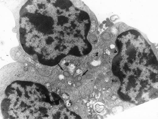 Fig. 5. Typical synartesis (arrows) can be induced between control erythroblasts, when grown in the presence of patient isolated IgG fraction (shown here, patient 2). Original magnification ×16,100.