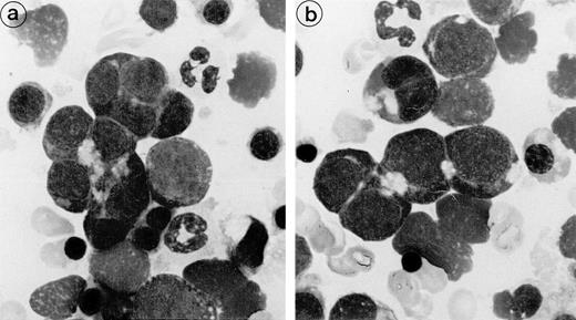 Fig. 1. Bone marrow smear (patient 2): The erythroblasts are numerous and several of them are closely apposed to each other. At the intercellular junction, a clear nonbasophilic zone is evident.