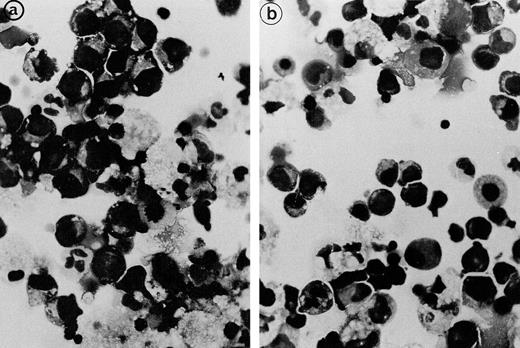 Fig. 4. Light microscopical aspect of the erythroblasts cultured from patient 2 bone marrow. (a) In the presence of autologous serum: The erythroblasts are closely apposed to each other with occasional nonbasophilic areas present at their junction, mimicking the morphology of the bone marrow smears. (b) In the presence of a control serum: The grown erythroblasts are scattered and individually disposed on this cytospun preparation and do not display the characteristic abnormalities of the disease.