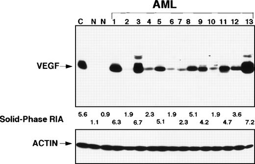 Fig. 1. Western blot. In lane C is a positive control, the next 2 lanes show control from 2 normal bone marrows. Lanes 1 through 13 show a considerable variability in expression of VEGF that was confirmed with RIA.