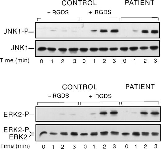 Fig. 3. Comparison of JNK1 and ERK2 activation in a Glanzmann’s thrombasthenia patient and control. Washed platelets from control in the presence or absence of RGDS peptide and patient were stimulated with 0.2 U/mL of thrombin under stirring conditions at the indicated times. Then platelet lysates were solubilized and analyzed for ERK2 and JNK1 activation.