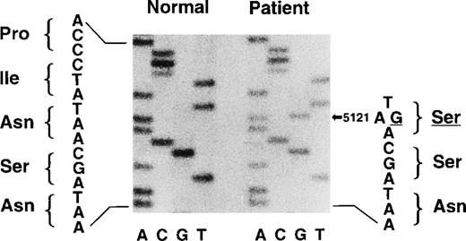 Fig. 4. Direct nucleotide sequencing of PCR-amplified exon IV of the patient-derived fibrinogen Bβ-chain gene. The DNA sample of PCR-amplified exon of patient’s fibrinogen Bβ-chain gene was subjected to urea-PAGE and subsequently to autoradiography. Part of the autoradiogram is shown. The arrow indicates the mutation of G for A at position 5121, coding Ser (TGA) for Asn (TAA) at position 160 of the fibrinogen β chain.