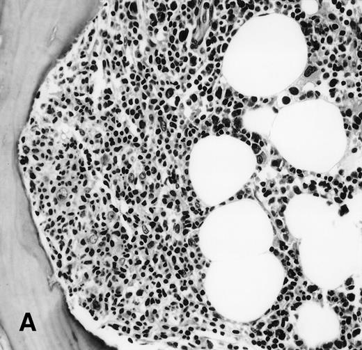 Fig. 1. (A) BM biopsy showing a paratrabecular lymphoid infiltrate of atypical lymphoid cells, diagnostic of involvement by malignant lymphoma and confirmed by CD20+immunohistochemical staining. A lymph node biopsy showed a follicular lymphoma. Flow cytometric studies demonstrated polyclonal B cells with no monoclonal B-cell population identified (H&E; original magnification × 400). (B) BM biopsy showing a nodular lymphoid infiltrate of atypical, large lymphoid cells, diagnostic of involvement by malignant lymphoma and confirmed by CD20+ immunohistochemical staining. A lymph node biopsy showed a large-cell lymphoma. Flow cytometric studies of the marrow aspirate demonstrated polyclonal B cells with no monoclonal B-cell population identified (H&E; original magnification ×400).