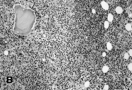 Fig. 1. (A) BM biopsy showing a paratrabecular lymphoid infiltrate of atypical lymphoid cells, diagnostic of involvement by malignant lymphoma and confirmed by CD20+immunohistochemical staining. A lymph node biopsy showed a follicular lymphoma. Flow cytometric studies demonstrated polyclonal B cells with no monoclonal B-cell population identified (H&E; original magnification × 400). (B) BM biopsy showing a nodular lymphoid infiltrate of atypical, large lymphoid cells, diagnostic of involvement by malignant lymphoma and confirmed by CD20+ immunohistochemical staining. A lymph node biopsy showed a large-cell lymphoma. Flow cytometric studies of the marrow aspirate demonstrated polyclonal B cells with no monoclonal B-cell population identified (H&E; original magnification ×400).