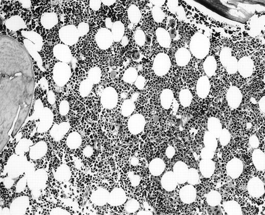 Fig. 2. BM biopsy showing a normocellular marrow with no morphologic features of lymphoma, confirmed by negative immunohistochemical staining. A lymph node biopsy showed a large-cell lymphoma. Flow cytometric studies of the marrow aspirate demonstrated a small population of monoclonal B cells (H&E; original magnification × 400).